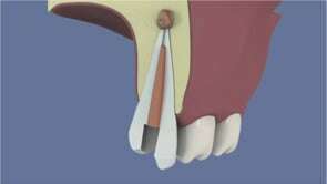 La procédure de retraitement canalaire