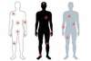 traitement fibromyalgie fibro osteopathe osteopathie