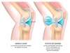 genou arriere kyste poplite osteo osteopatie suresnes 92150