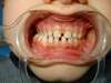 Intrabuccale face - Avant traitement 1 (04-03-2024) - 1