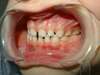 Intrabuccale gauche - Avant traitement 1 (04-03-2024) - 2