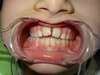 Intrabuccale face - Avant traitement 1 (03-03-2018) - 1 2