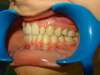 Intrabuccale gauche - Fin de traitement (15-01-2024) - 54 1