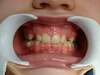 Intrabuccale face - Avant traitement 1 (25-01-2021) - 2