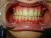 Intrabuccale face - Fin de traitement (10-06-2024) - 40