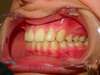 Intrabuccale gauche - Fin de traitement (10-06-2024) - 41