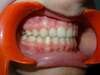 Intrabuccale droite - Fin de traitement (16-10-2023) - 65