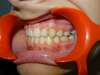 Intrabuccale gauche - Fin de traitement (16-10-2023) - 64