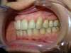 Intrabuccale gauche - Fin de traitement (22-09-2024) - 22