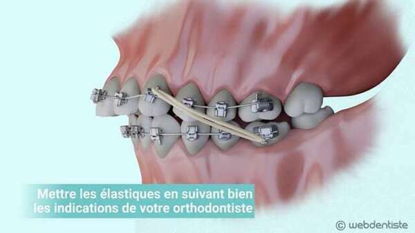 Les élastiques de classes ii et iii