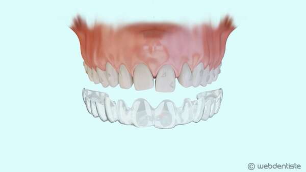 Traitement orthodontique esthétique par gouttières