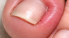 L’ongle incarné : une pathologie douloureuse