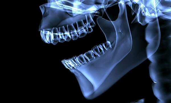 Cas clinique : Dentisterie Adhésive / Dentisterie Esthétique