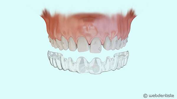 Traitement orthodontique esthétique par gouttières