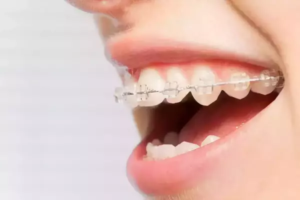 LES REGLES D'OR APRES LA POSE D'UN APPAREIL ORTHODONTIQUE