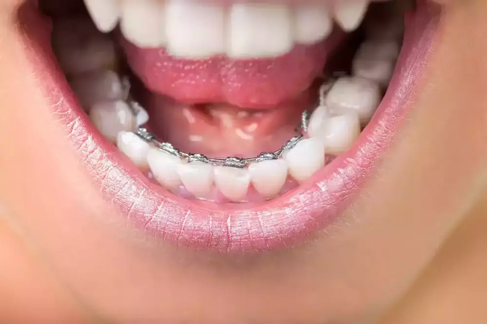 LA CONTENTION ORTHODONTIQUE
