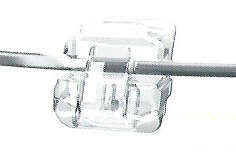 Système autoligaturant DAMON Clear