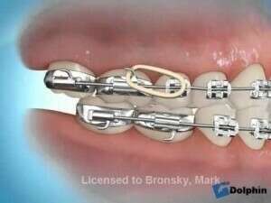 Correction avec élastique classe 3