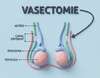 definition et fonctionnement de la vasectomie