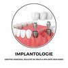 Implantologie à Metz : illustration d'implants dentaires posés dans la mâchoire