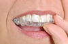 Aligners transparents et amovibles pour orthodontie adulte esthétique et confortable
