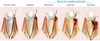 stade-maladie-parodontale