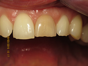 Facettes dentaires, cas 1 : sourire avant traitement