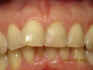 Facettes dentaires, cas 2 : sourire avant traitement