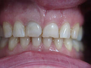 Couronnes céramique sans métal sur dents antérieures, cas 1 avant