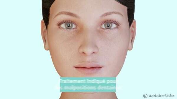 Appareil multi-attache en céramique