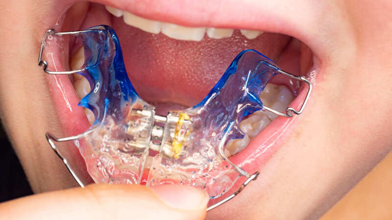 Orthodontie de l'enfant, Dr Karine PERRIN LEFEBVRE à Annemasse (74100)