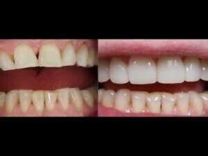 LUMINEERS les facettes sans taille