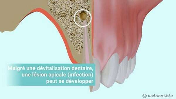 La résection apicale