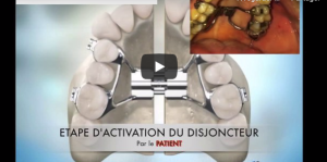 Disjonction palatine/maxillaire chirurgicale