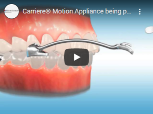 Carrière Motion Appliance avec gouttière essix