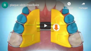 Plaque vérin maxillaire