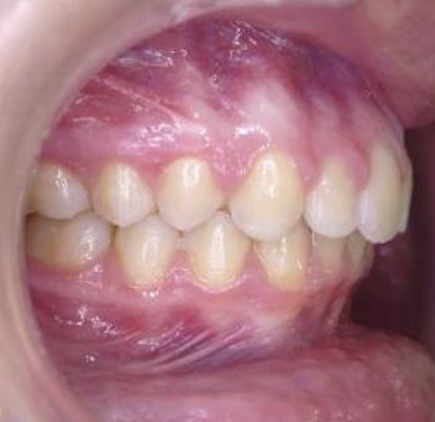 Le DDEU : Dispositif de Distalisation et Egression Unilatérale