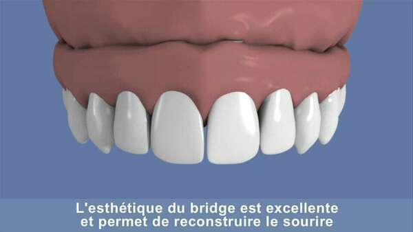 Maxillaire complet et traitement implantaire pour un bridge fixe scellé