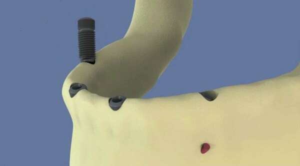 Mandibule : all-on-4