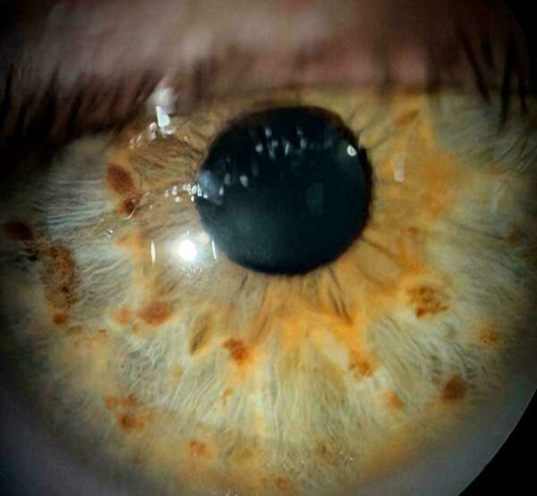 La maladie ou syndrome de l’œil sec