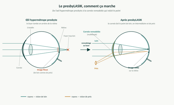 Avez vous pensé à voir sans lunettes?