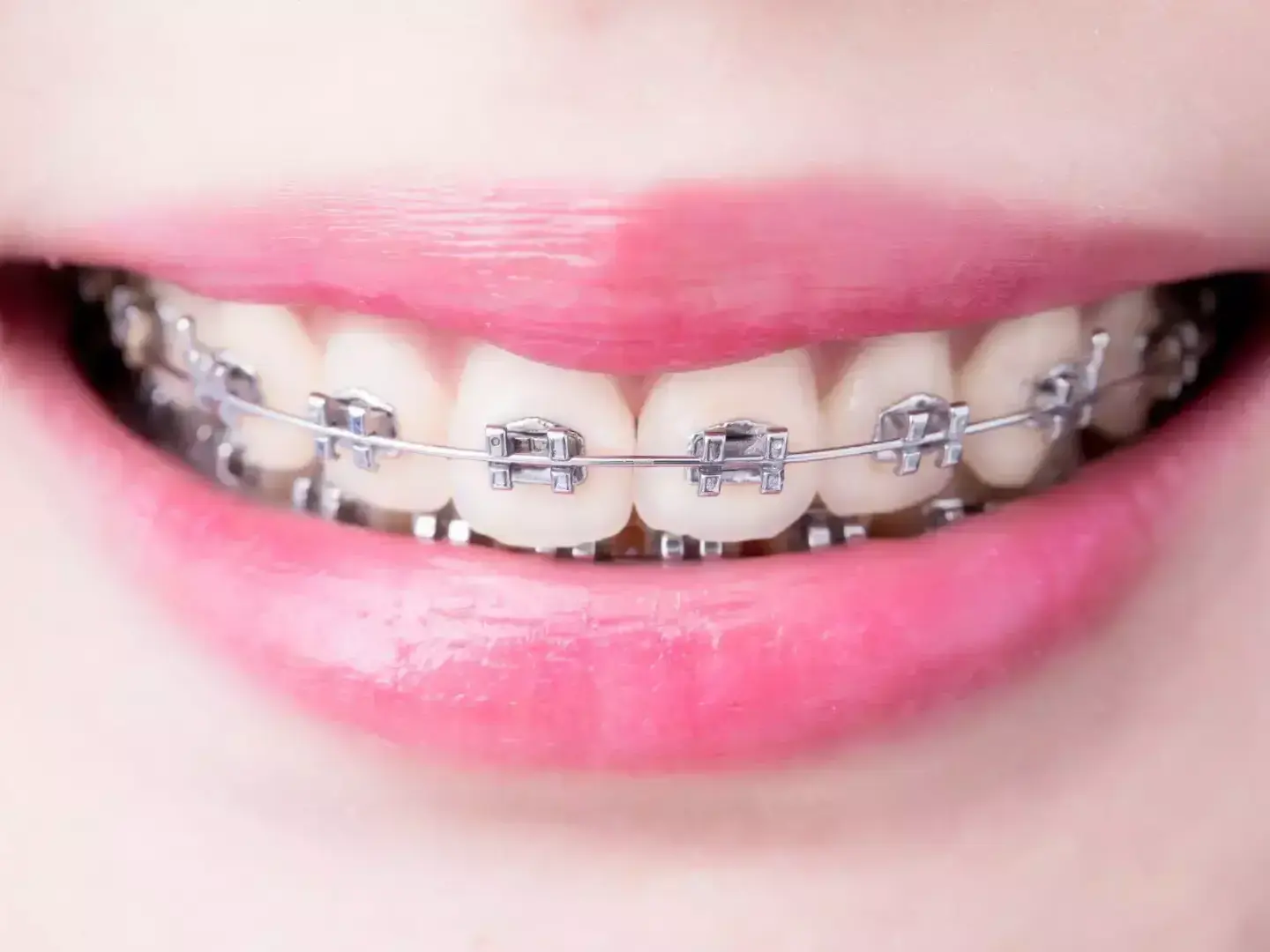 Sourire avec appareil orthodontique à plaquettes, vue rapprochée