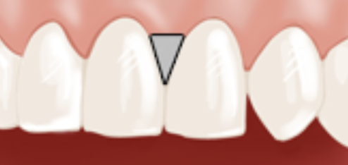 STRIPPING DENTAIRE (OU REMODELAGE DENTAIRE)