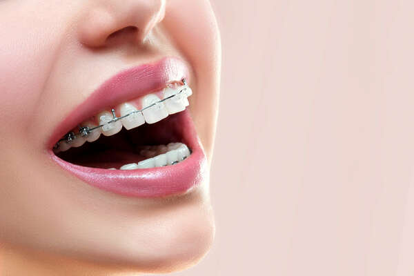 LES TRAITEMENTS ORTHODONTIQUES POUR ADULTE