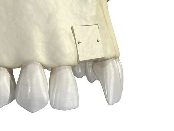 La greffe osseuse d'apposition ou greffe en onlay