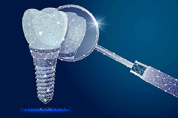 La chirurgie guidée en implantologie