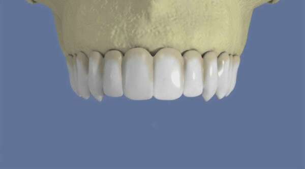 Maxillaire : bridge vissé sans fausse gencive