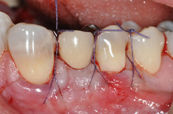 Cas cliniques : greffe gingivale à visée esthétique au Cabinet Dentaire du Docteur Picard, à Rouen.