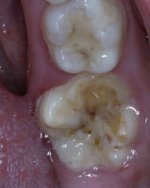 coiffes préfromées avant