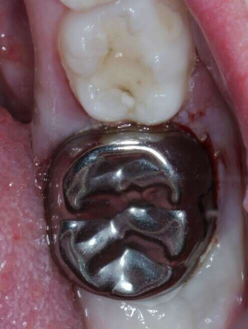 coiffes préfromées après